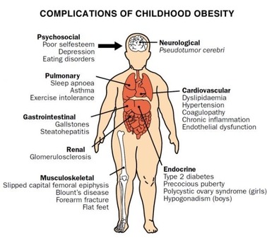 Childhood_obesity.jpg